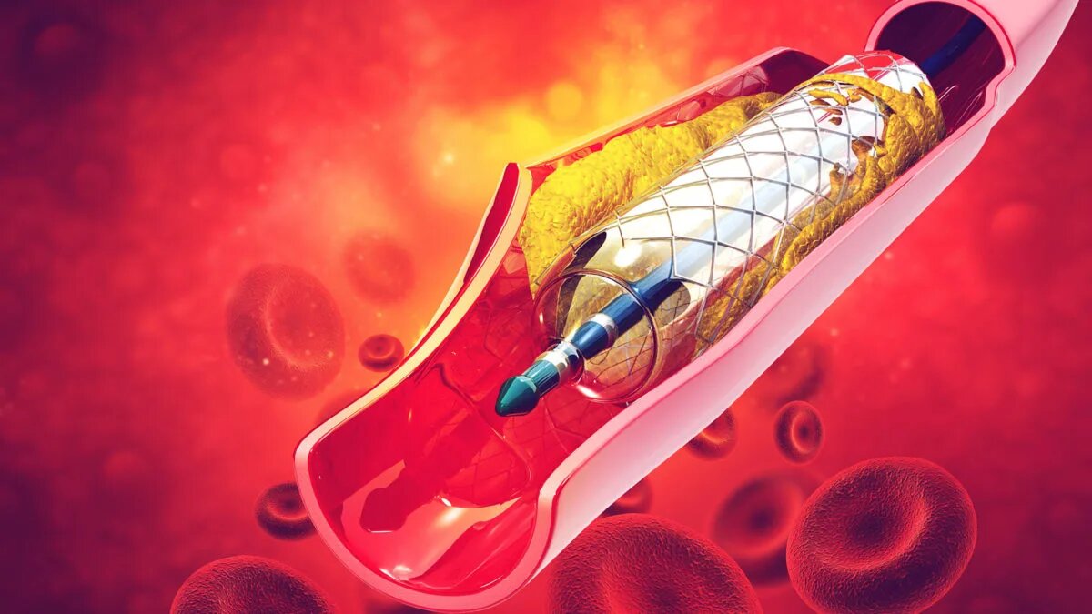 Coronary artery disease