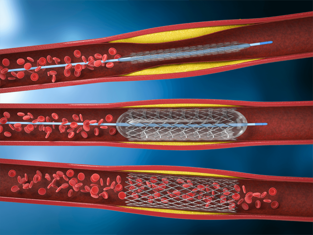 severe aortic stenosis