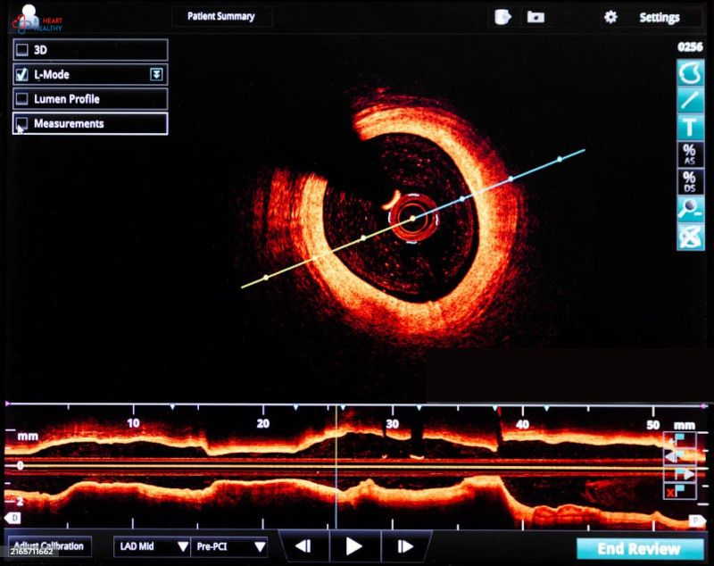 oct in cardiology